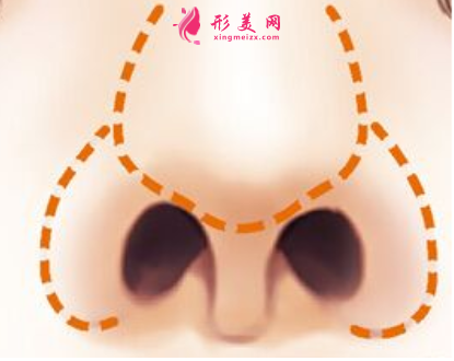 做鼻翼縮小手術(shù)安不安全