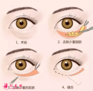 手術(shù)祛眼袋的誤區(qū)你清楚嗎？