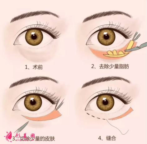 手術(shù)祛眼袋的誤區(qū)你清楚嗎