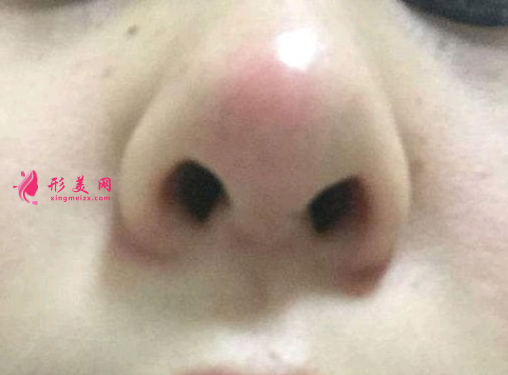 隆鼻失敗修復(fù)要多少錢