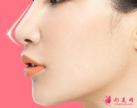 隆鼻失敗修復(fù)要多少錢