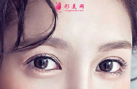 割雙眼皮眼睛會(huì)變大嗎