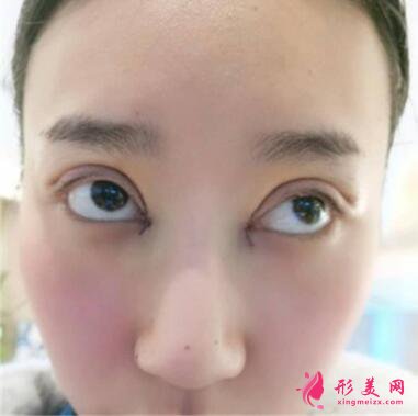 感受田永成雙眼皮技術(shù)的精細(xì)效果怎么樣，真實(shí)案例照片