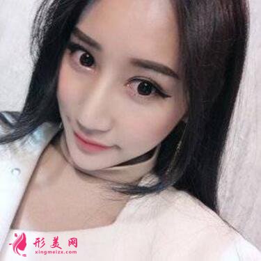 感受田永成雙眼皮技術(shù)的精細(xì)效果怎么樣，真實(shí)案例照片