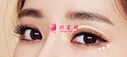 埋線雙眼皮一般需要花費(fèi)多少錢