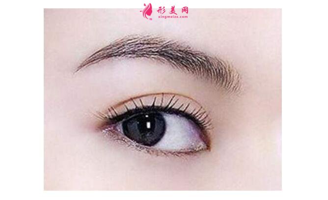 割雙眼皮開眼角價格