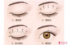 崔勁松醫(yī)療美容割雙眼皮開眼角價(jià)格是多少？