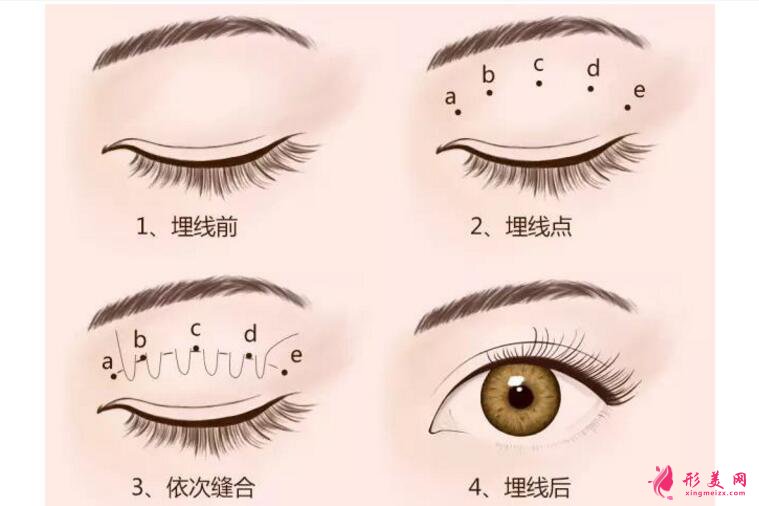 割雙眼皮開眼角價格
