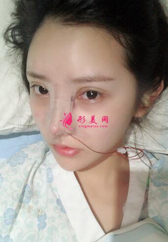 假體隆鼻過(guò)程分享及術(shù)后恢復(fù)效果展示~