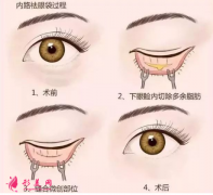 手術(shù)祛眼袋的一般費(fèi)用？