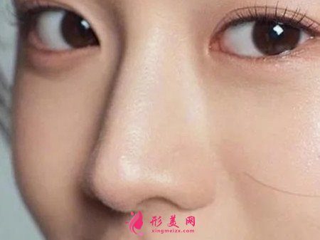 假體隆鼻有什么風險嗎