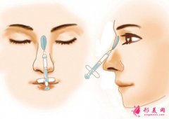 玻尿酸隆鼻會讓鼻子增寬是真的嗎?