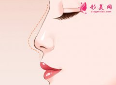 南京假體隆鼻的價(jià)格是多少？