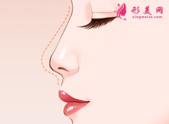 南京假體隆鼻的價格是多少