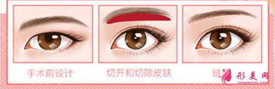 提眉術的原理