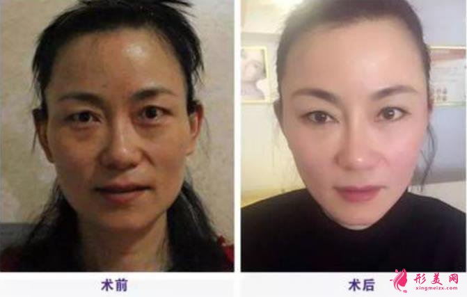 提眉術適合多少歲的人做?