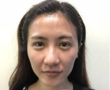 廣州藝美張濤自體脂肪填充全臉怎么樣？真人案例分享