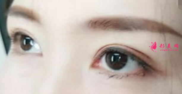 雙眼皮割得太深有什么危害嗎