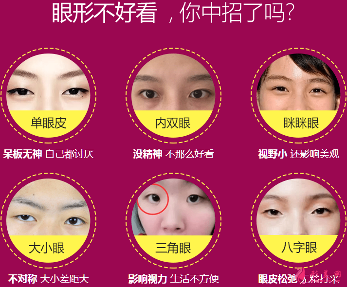 廣州美萊做雙眼皮的效果怎么樣