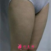 純脂醫(yī)療美容馮斌院長(zhǎng)大腿抽脂案例效果分享