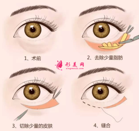 手術(shù)祛眼袋會有難看的疤痕嗎