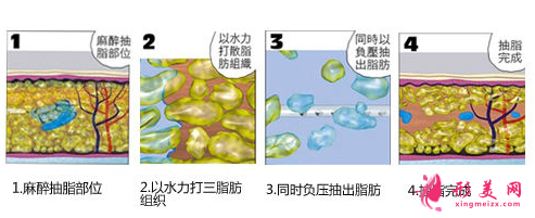 上臂吸脂一般什么價(jià)位