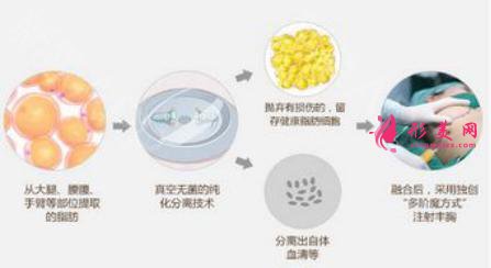 自身脂肪隆胸手術(shù)比假體好嗎
