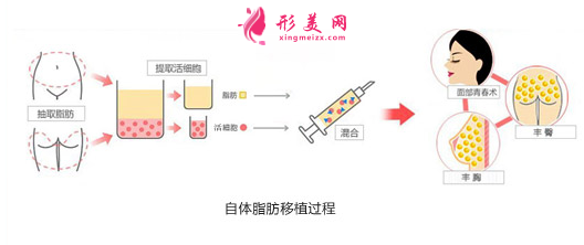 自身脂肪隆胸手術(shù)比假體好嗎