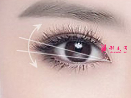開內(nèi)眼角多久才能恢復(fù)自然