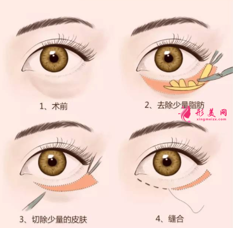 手術(shù)祛眼袋恢復(fù)期內(nèi)會(huì)影響上班嗎