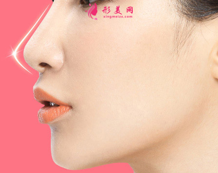 假體隆鼻效果能保持多少年