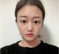 北京八大處靳小雷雙眼皮怎么樣？最近案例一覽|小仙女就此誕生!
