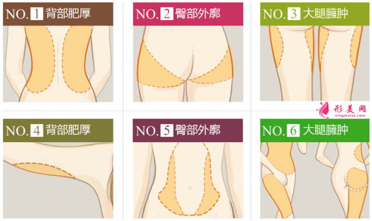 吸脂減肥手術(shù)有哪些優(yōu)勢