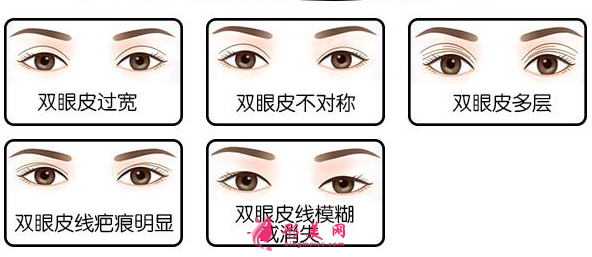 雙眼皮修復(fù)常見的類型