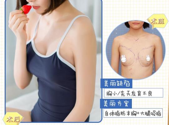 上海九院自體脂肪隆胸價(jià)格是多少?2022價(jià)目表分享~
