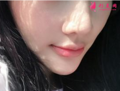 注射瘦臉針會有風險嗎？