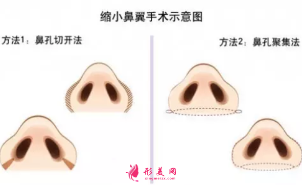 怎么樣快速縮小鼻翼