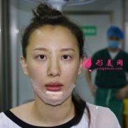 廣州韓妃整形醫(yī)院硅膠墊下巴怎么樣？真實(shí)案例分享