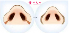 鼻翼縮小術(shù)后怎么快速恢復(fù)？