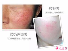 臉上有紅血絲怎么治？