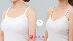 巨乳縮小術后多久能恢復？