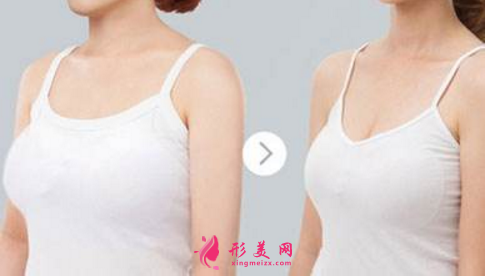 巨乳縮小術(shù)后多久能恢復(fù)