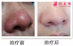 如何根治酒糟鼻—激光療法