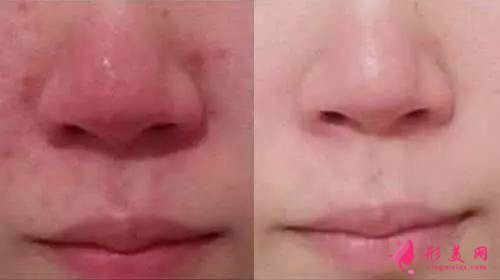 根治酒糟鼻—激光療法