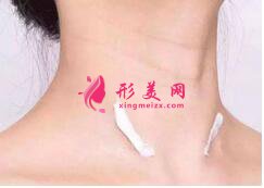 激光祛斑的效果如何？為什么肌膚會(huì)出現(xiàn)反黑現(xiàn)象?