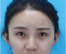 重慶華美張國強(qiáng)隆鼻怎么樣？真實(shí)案例分享