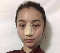 北京彤美醫(yī)療美容醫(yī)院埋線雙眼皮+鼻綜合整形手術效果圖對比照