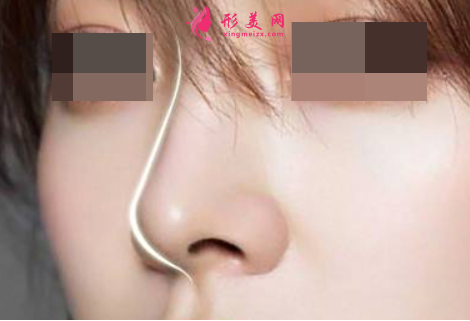 什么因素會(huì)導(dǎo)致軟骨隆鼻失敗