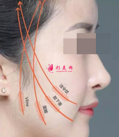 臉部埋線提升可以保持多少年