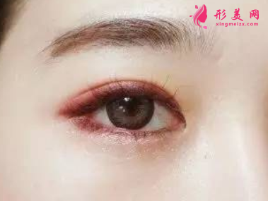 開(kāi)眼角常見(jiàn)的手術(shù)方法